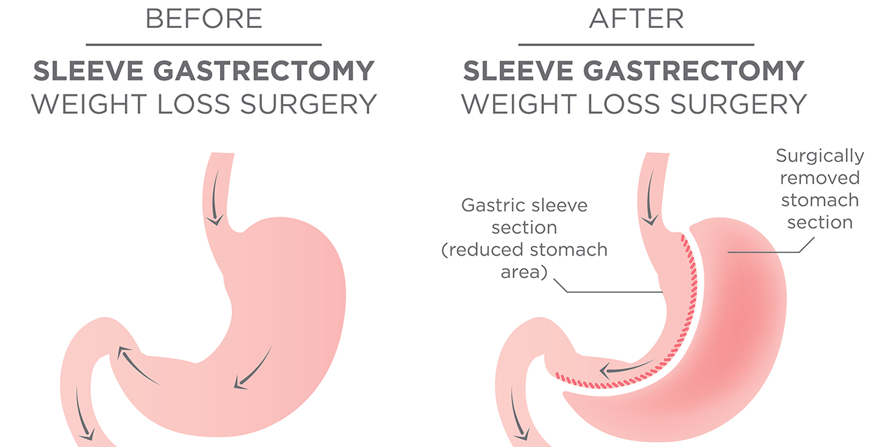 Sleeve Gastrectomy illustration